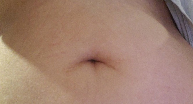 En términos generales, durante una manga gástrica laparoscópica tradicional, su médico realizará cinco pequeñas incisiones en su abdomen.